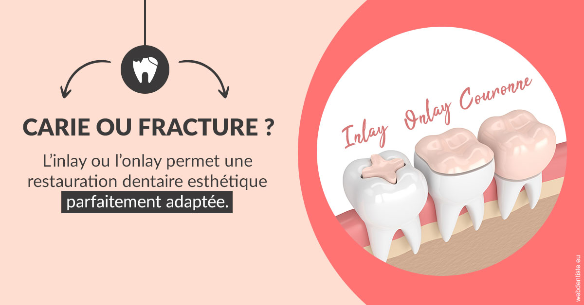 https://dr-jacques-sebastien.chirurgiens-dentistes.fr/T2 2023 - Carie ou fracture 2