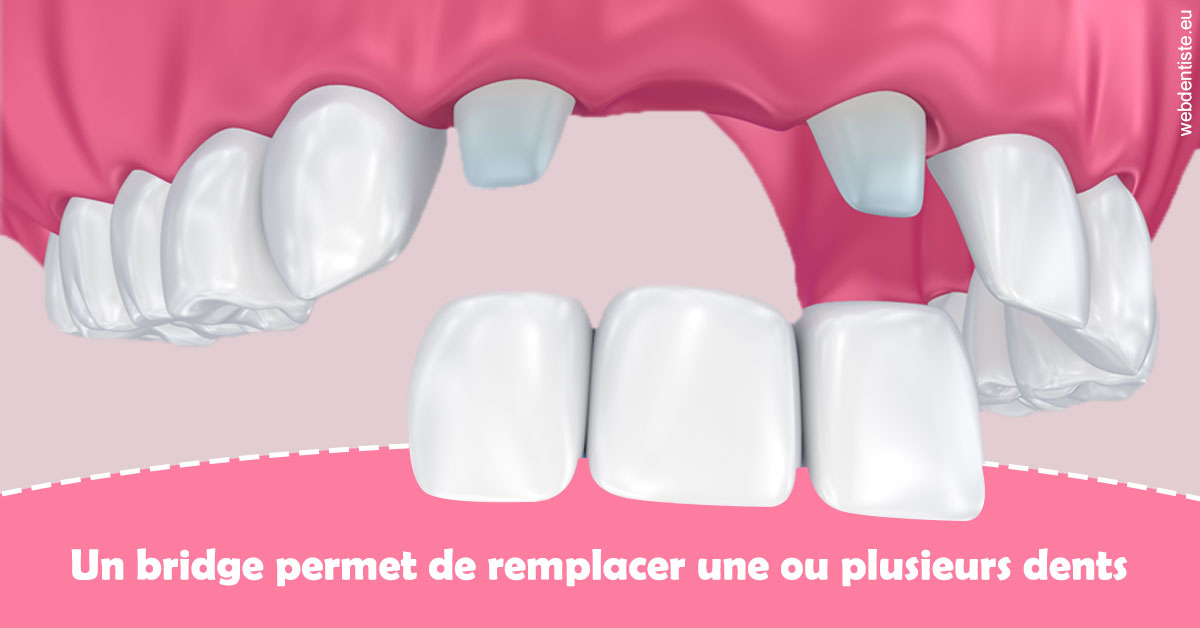 https://dr-jacques-sebastien.chirurgiens-dentistes.fr/Bridge remplacer dents 2