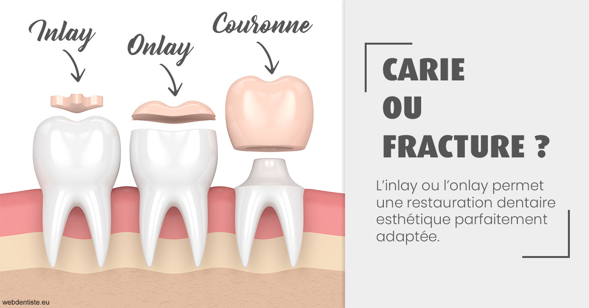 https://dr-jacques-sebastien.chirurgiens-dentistes.fr/T2 2023 - Carie ou fracture 1