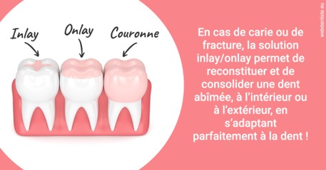 https://dr-jacques-sebastien.chirurgiens-dentistes.fr/L'INLAY ou l'ONLAY 2