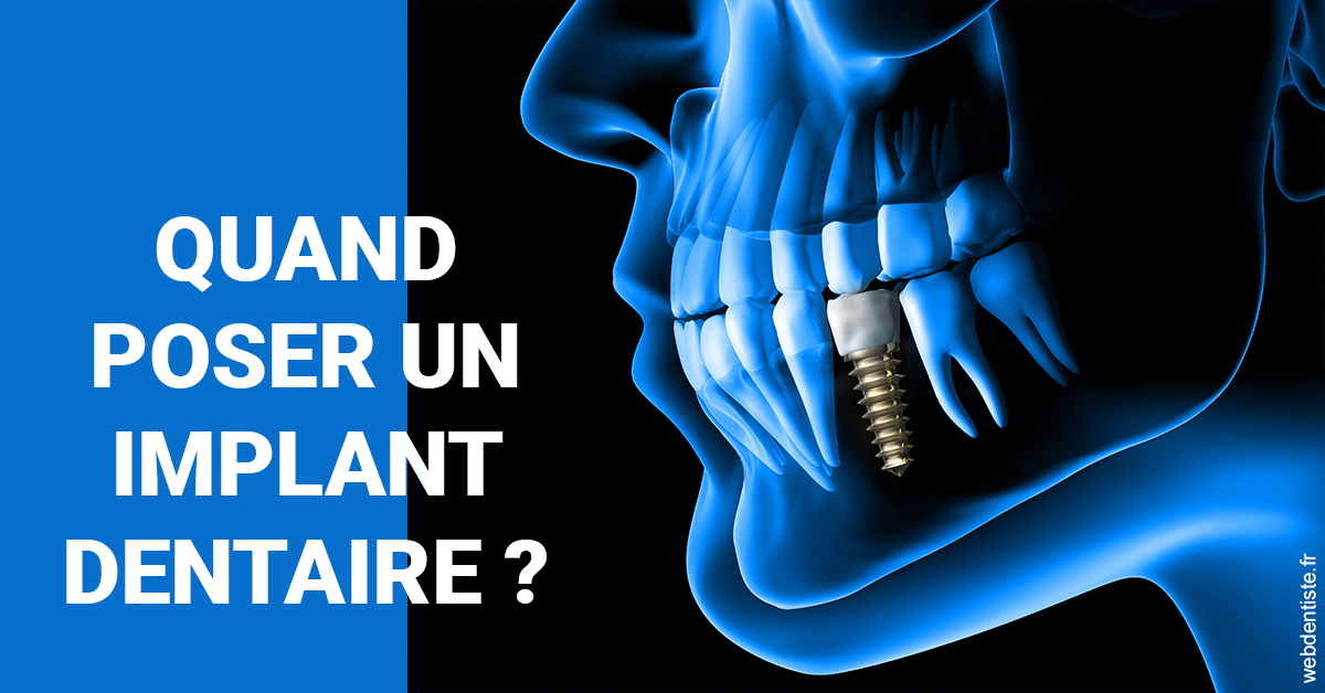 https://dr-jacques-sebastien.chirurgiens-dentistes.fr/Les implants 1