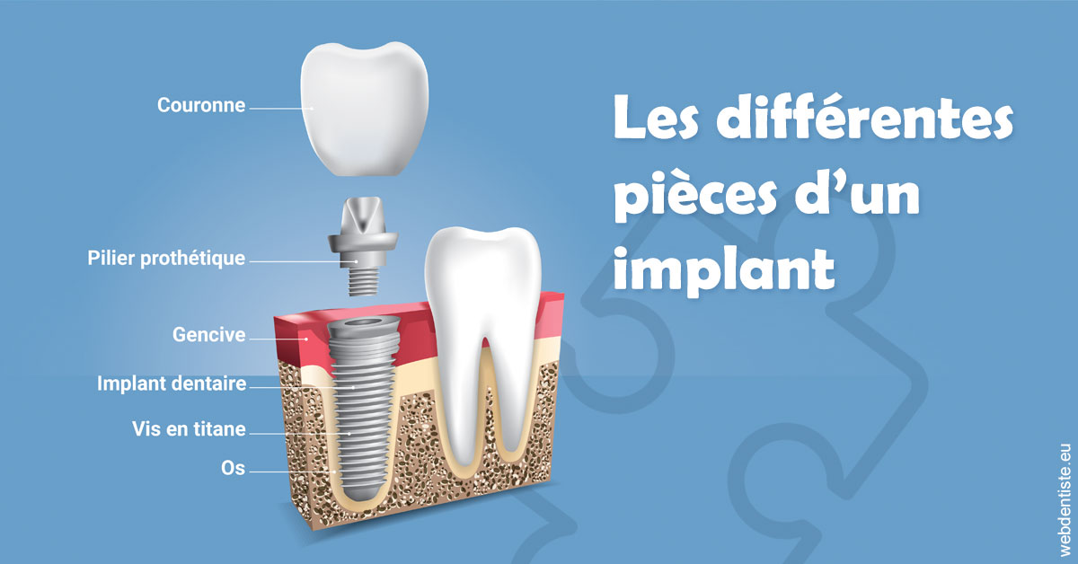https://dr-jacques-sebastien.chirurgiens-dentistes.fr/Les différentes pièces d’un implant 1